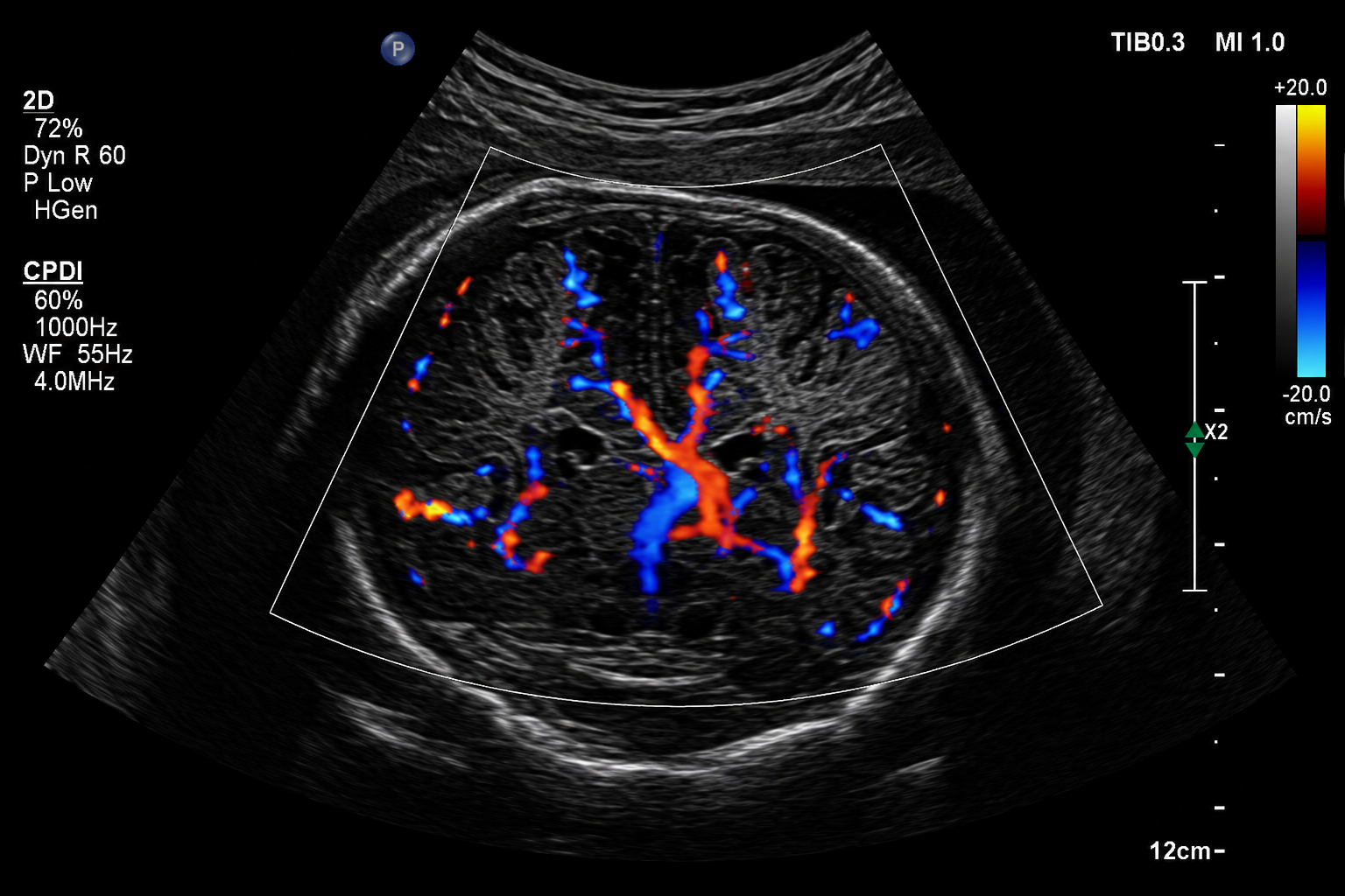 Imagen del Doppler en Arterias Cerebrales (Flujo sanguíneo)